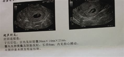 怀孕8个月b超图分析 8个月彩超图